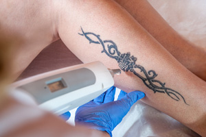 Tattoo Removal