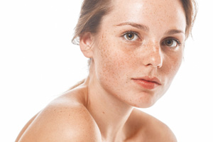Melasma (Freckles)