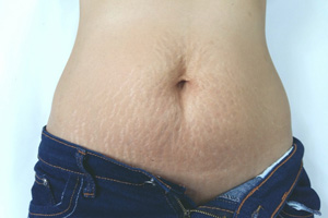 Stretch marks
