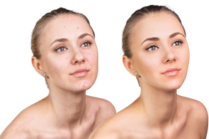 Facial Reconstruction With Nd-YAG Laser